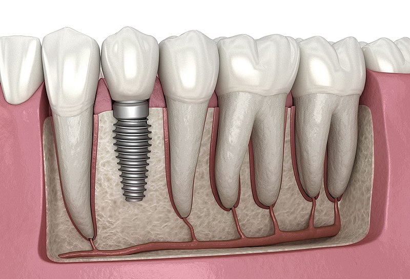 Dental Implants at the Alexandria Smile Center, Dentist in Alexandria, LA.