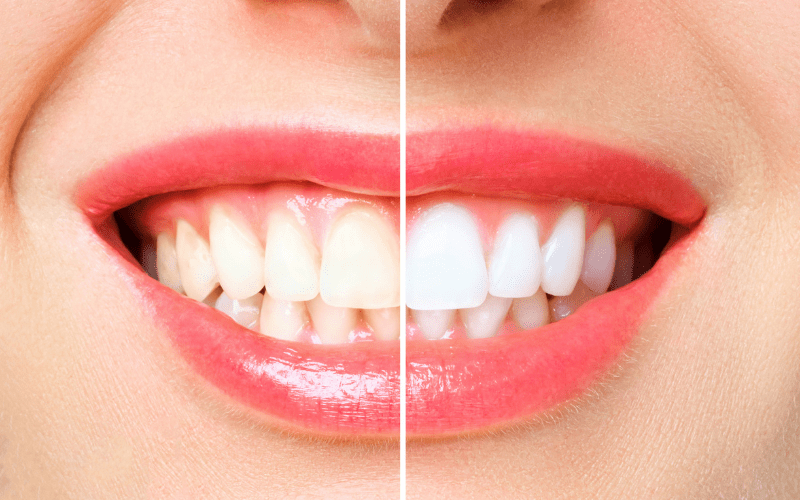 A before and After photos of Teeth Whitening at the Alexandria Smile Center | Dentist in Alexandria, LA