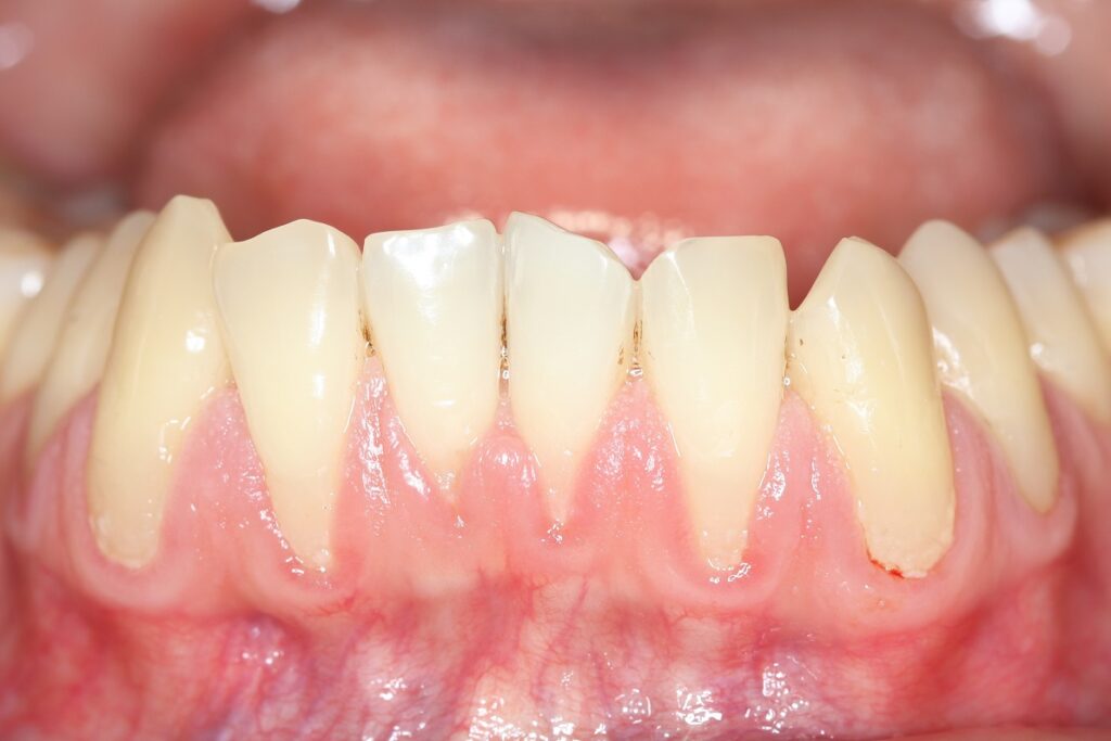 Gingival recession aka Gum recession | Alexandria Smile Center